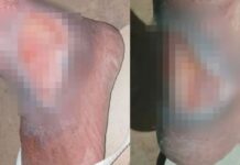 Médica descarta cirurgia e idoso sofre com feridas abertas nas pernas em Campo Grande